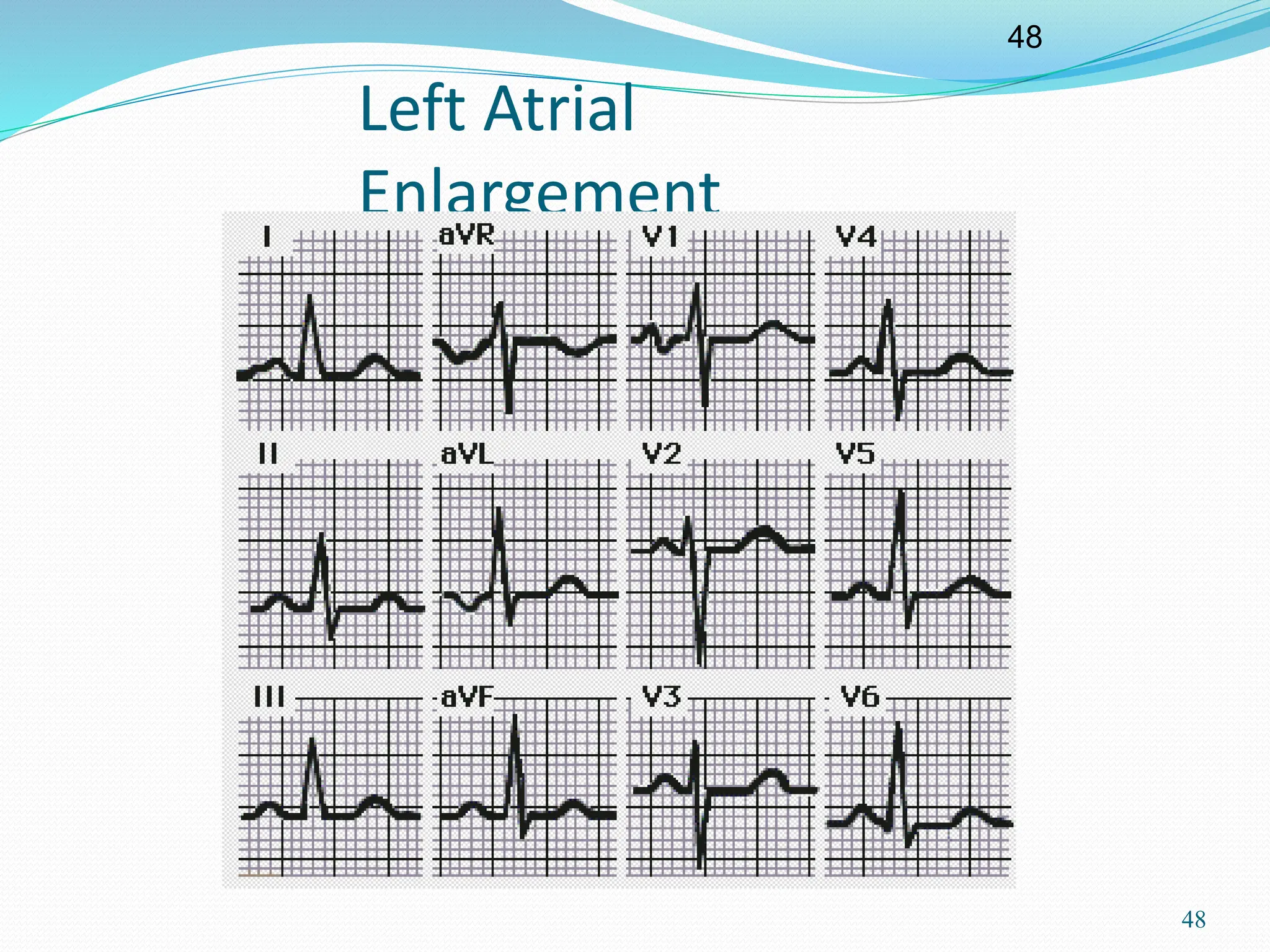48
48
Left Atrial
Enlargement
 
