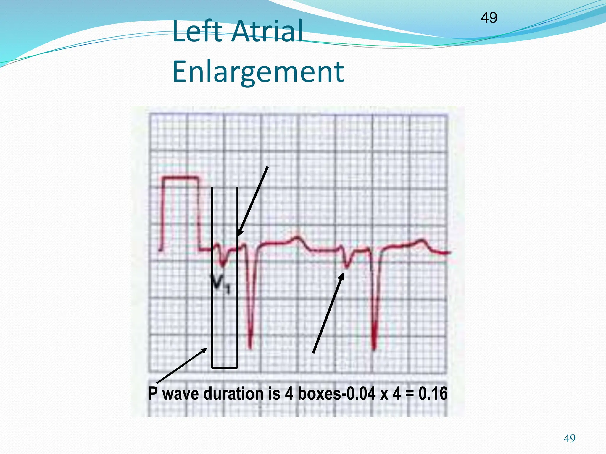 49
49
Left Atrial
Enlargement
P wave duration is 4 boxes-0.04 x 4 = 0.16
 