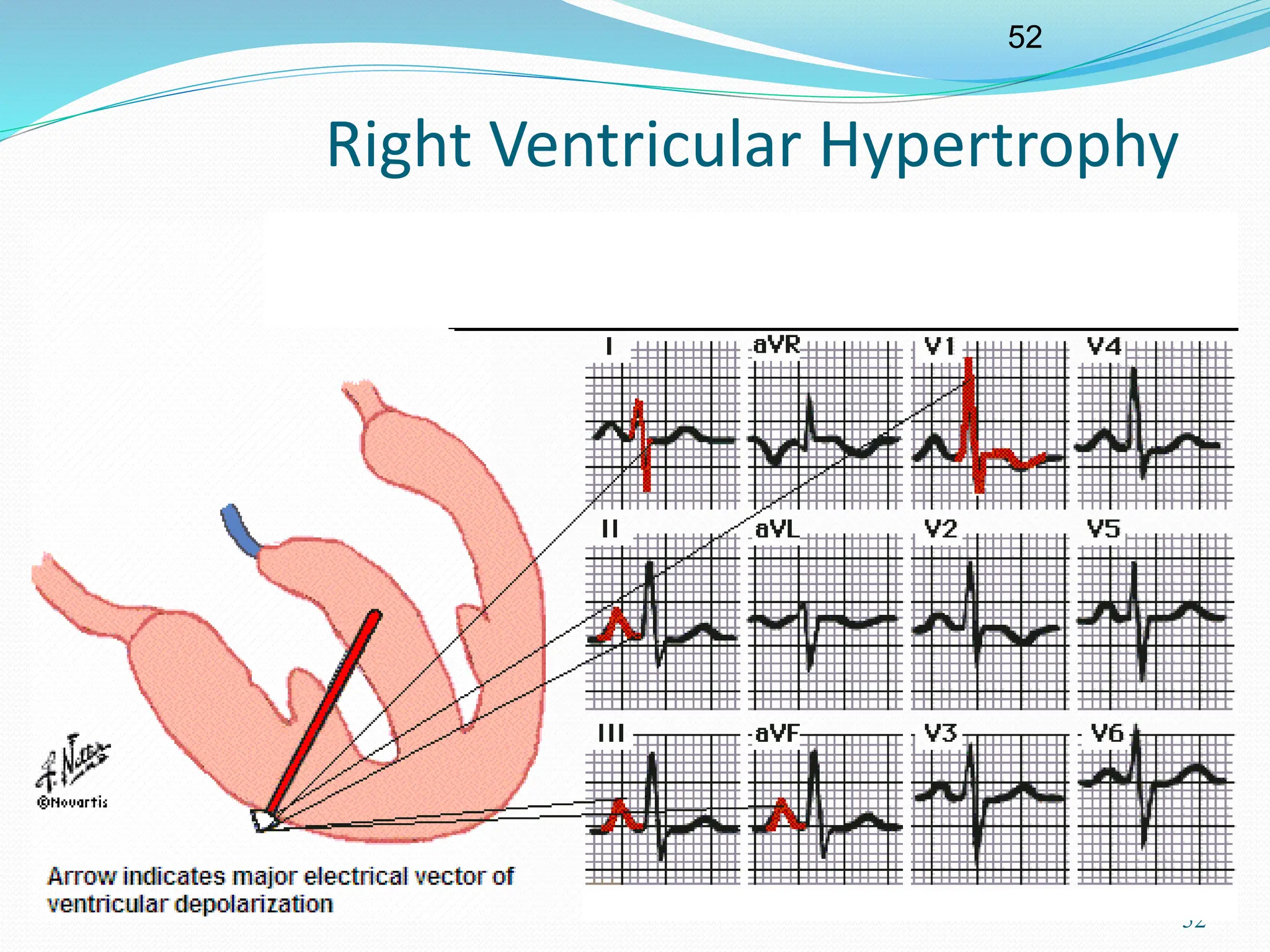 52
52
Right Ventricular Hypertrophy
 