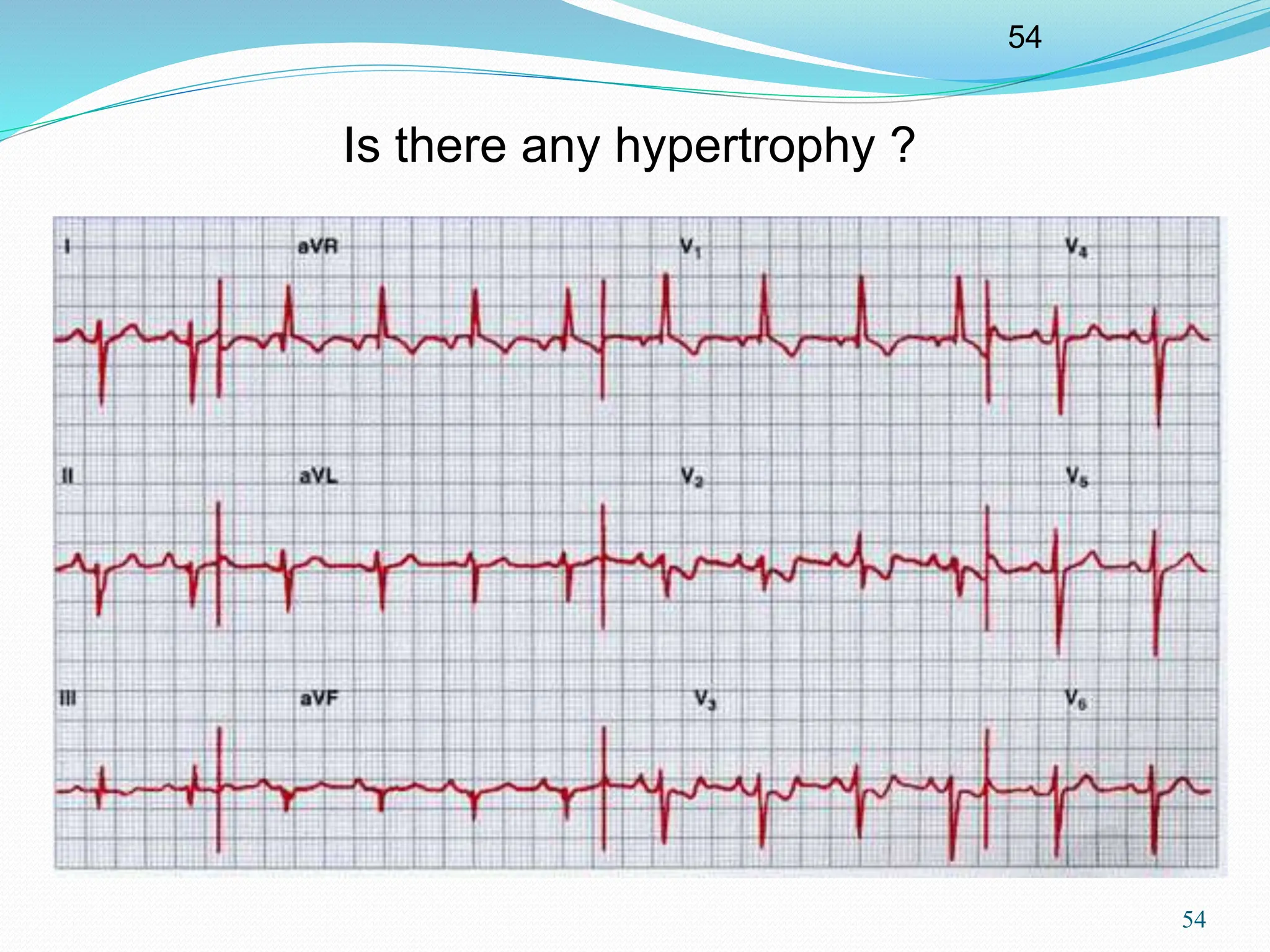 54
54
Is there any hypertrophy ?
 