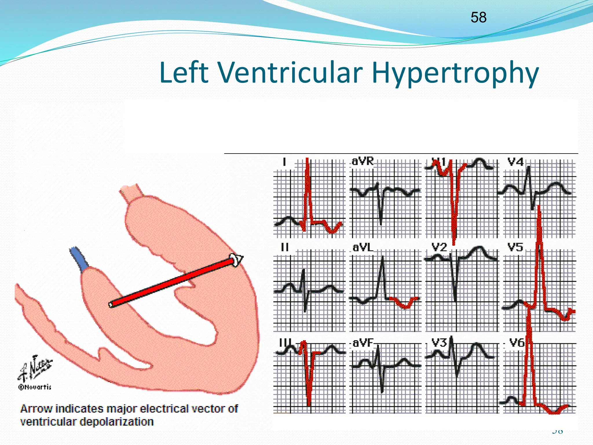 58
58
Left Ventricular Hypertrophy
 