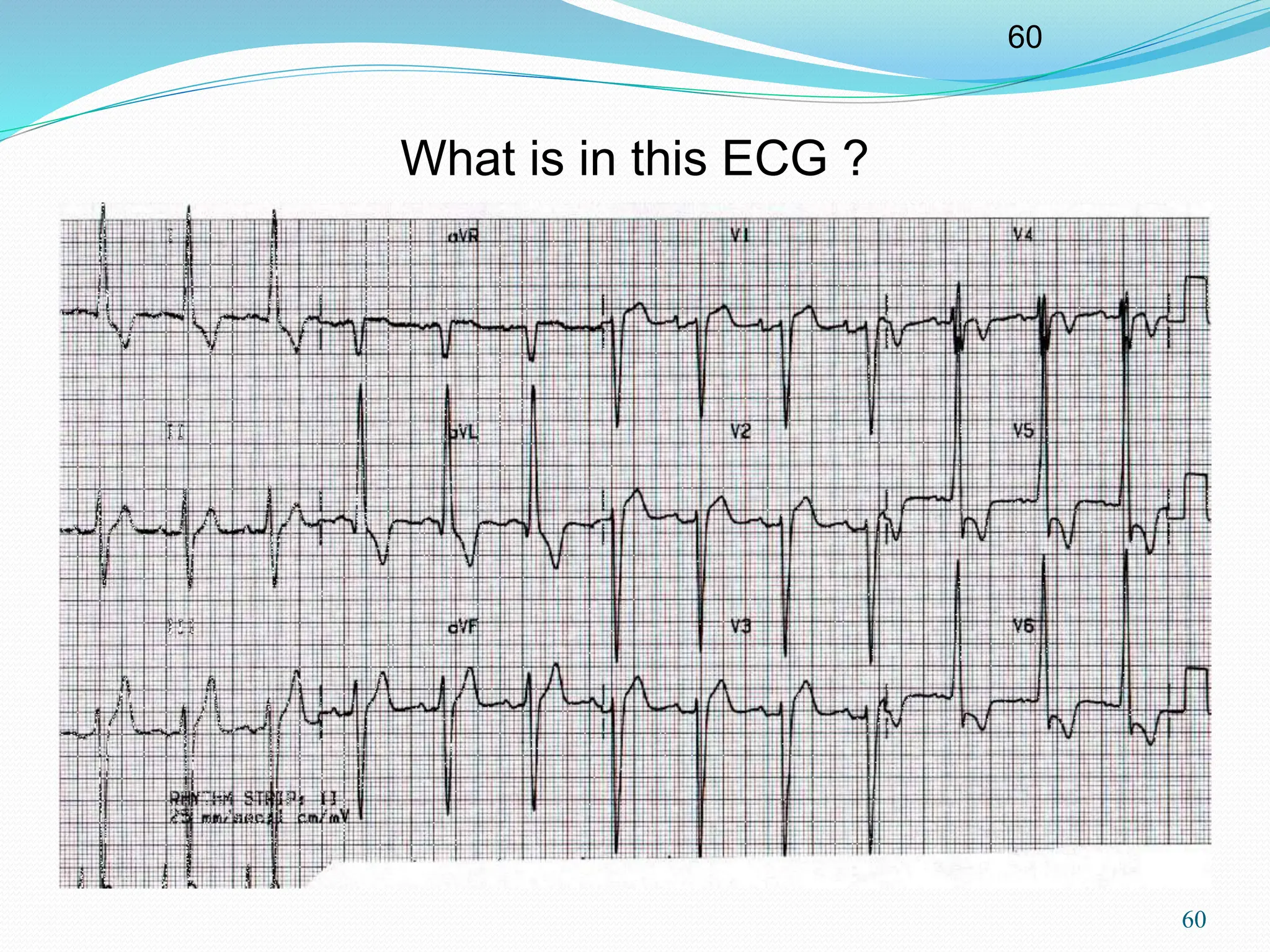 60
60
What is in this ECG ?
 