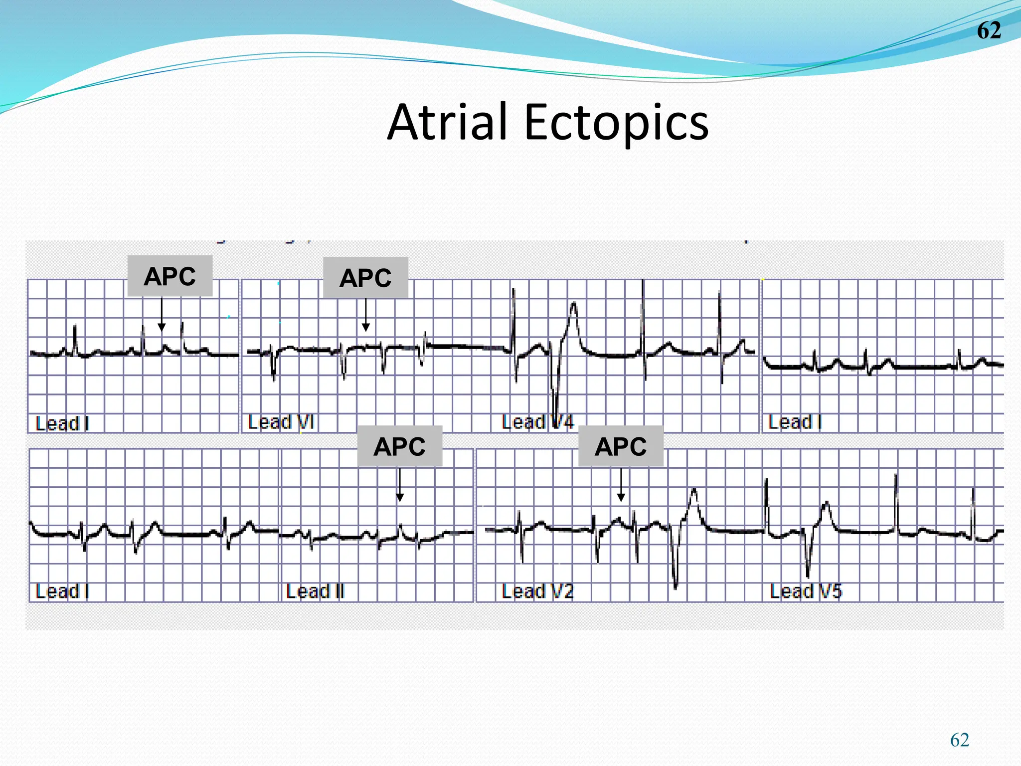 62
62
Atrial Ectopics
APC
APC
APC
APC
 
