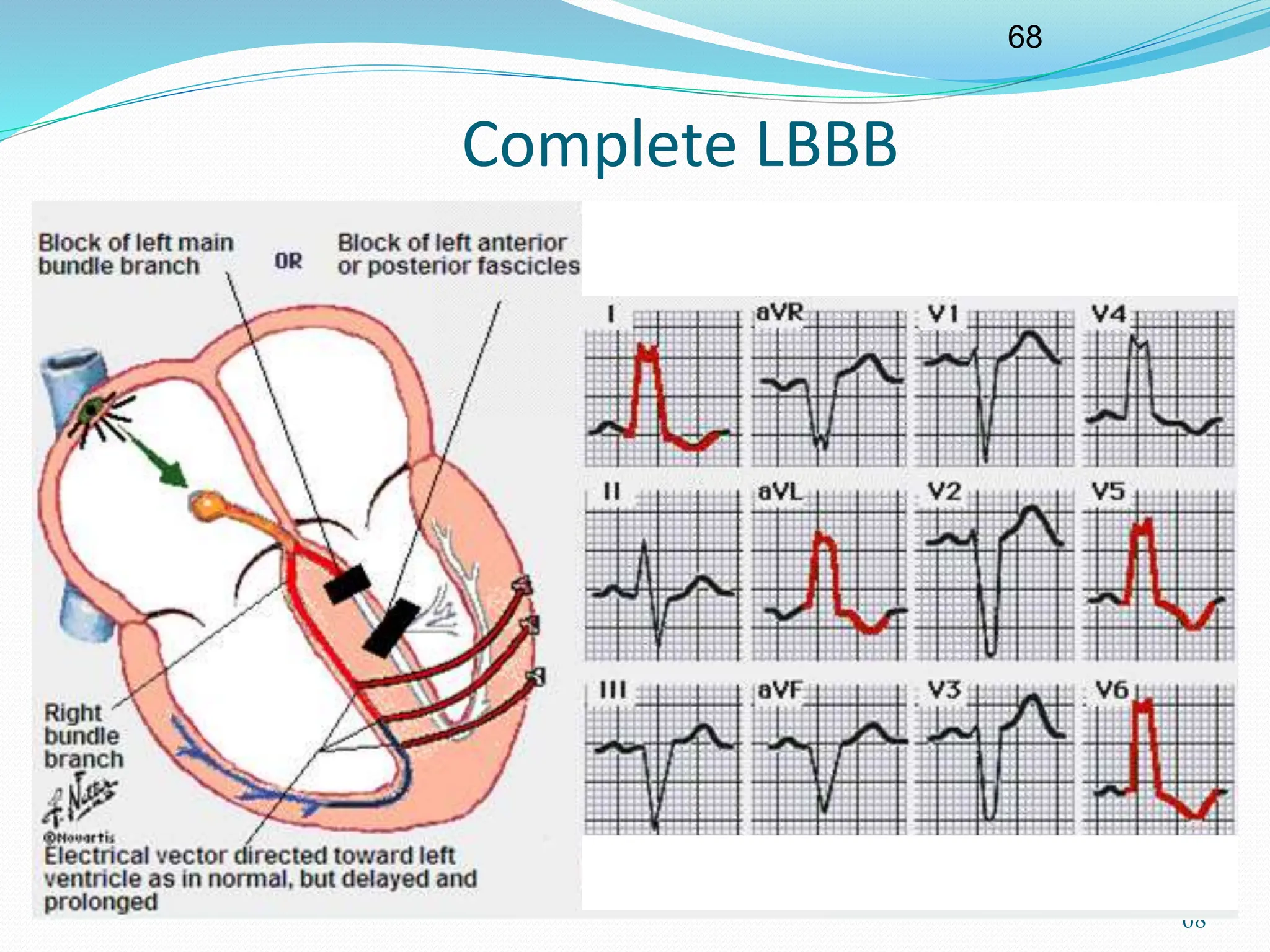 68
68
Complete LBBB
 