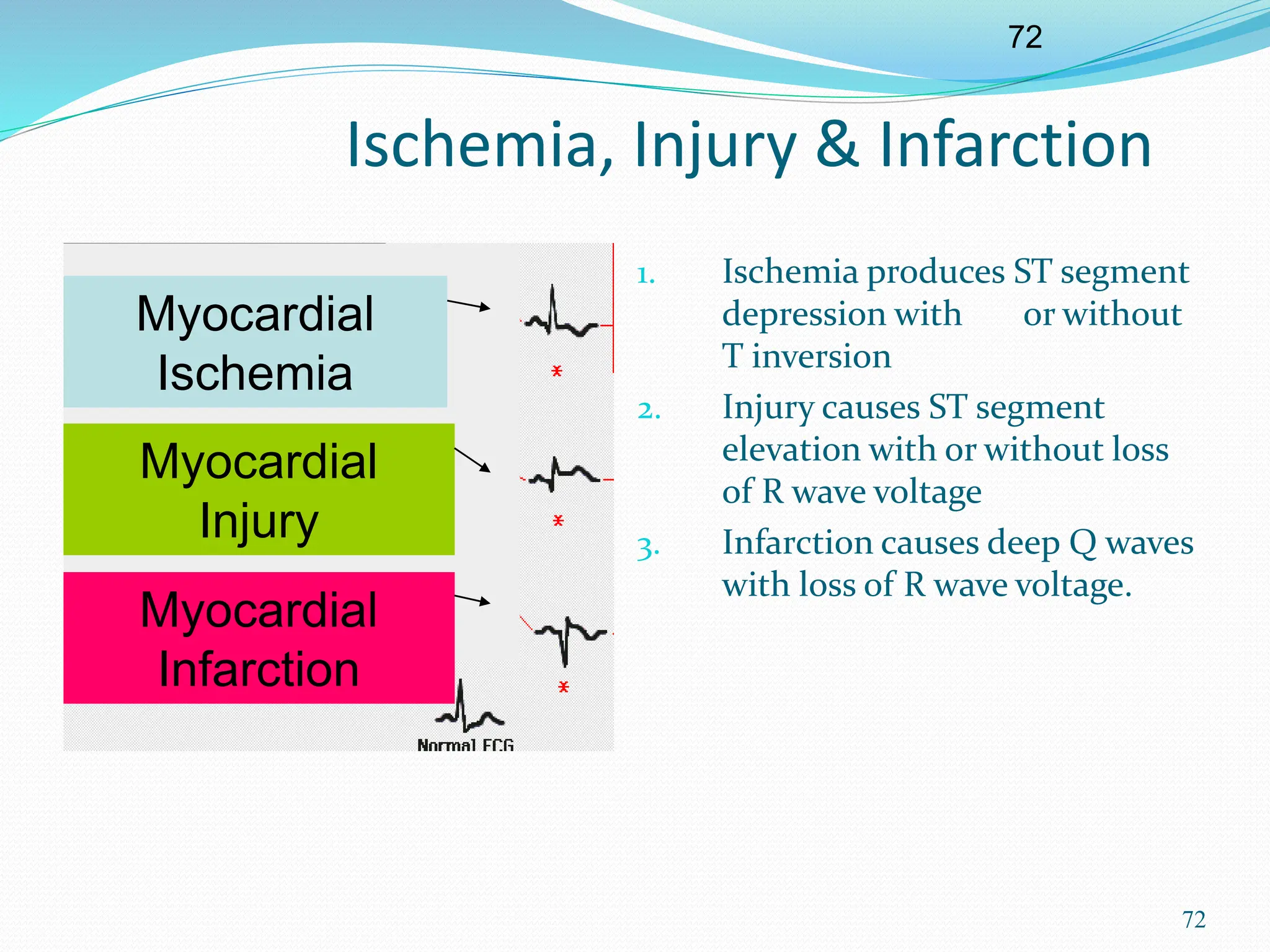 72
72
Ischemia, Injury & Infarction
Myocardial
Ischemia
Myocardial
Injury
Myocardial
Infarction
1. Ischemia produces ST segment
depression with or without
T inversion
2. Injury causes ST segment
elevation with or without loss
of R wave voltage
3. Infarction causes deep Q waves
with loss of R wave voltage.
 