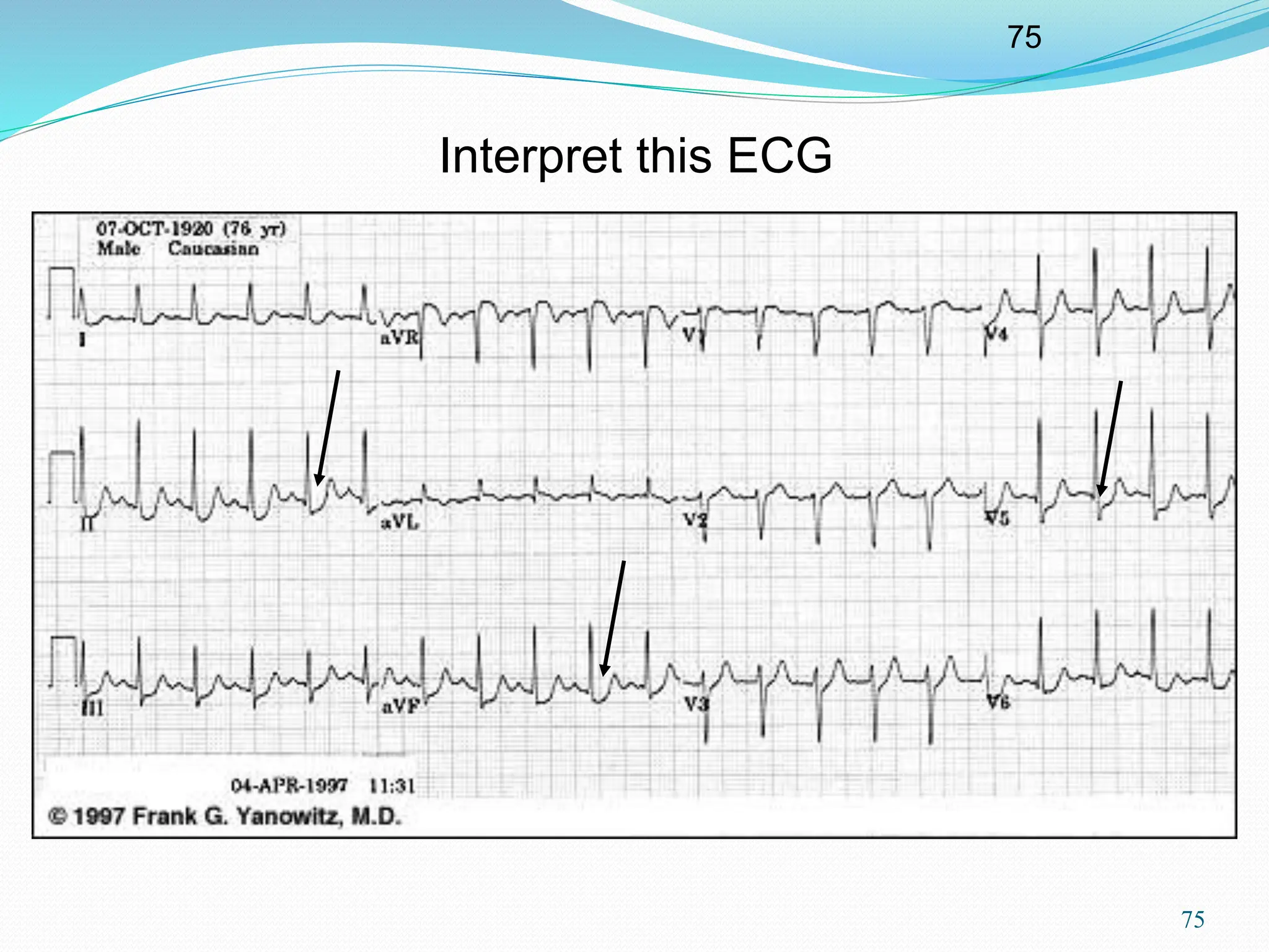 75
75
Interpret this ECG
 