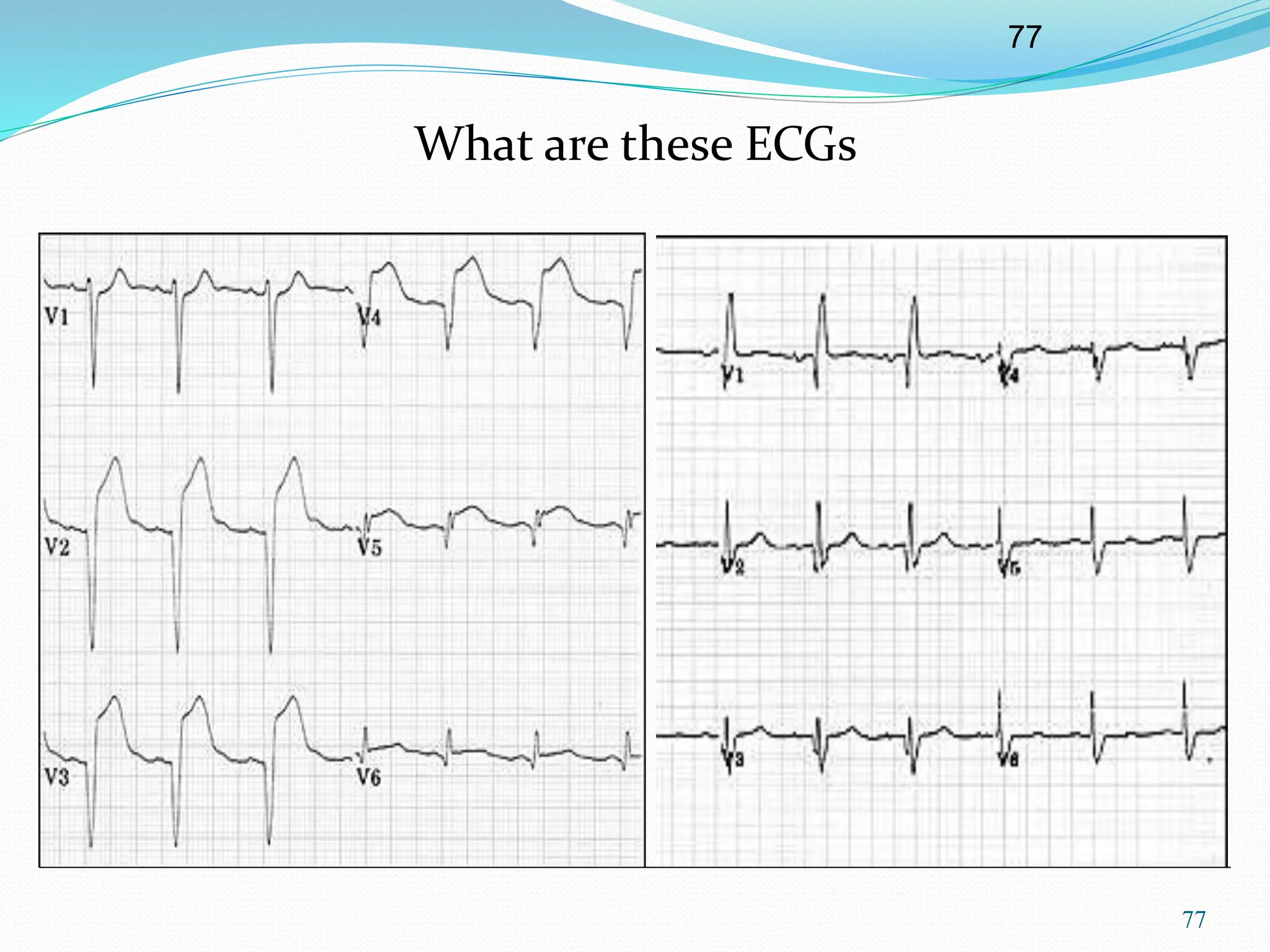 77
77
What are these ECGs
 