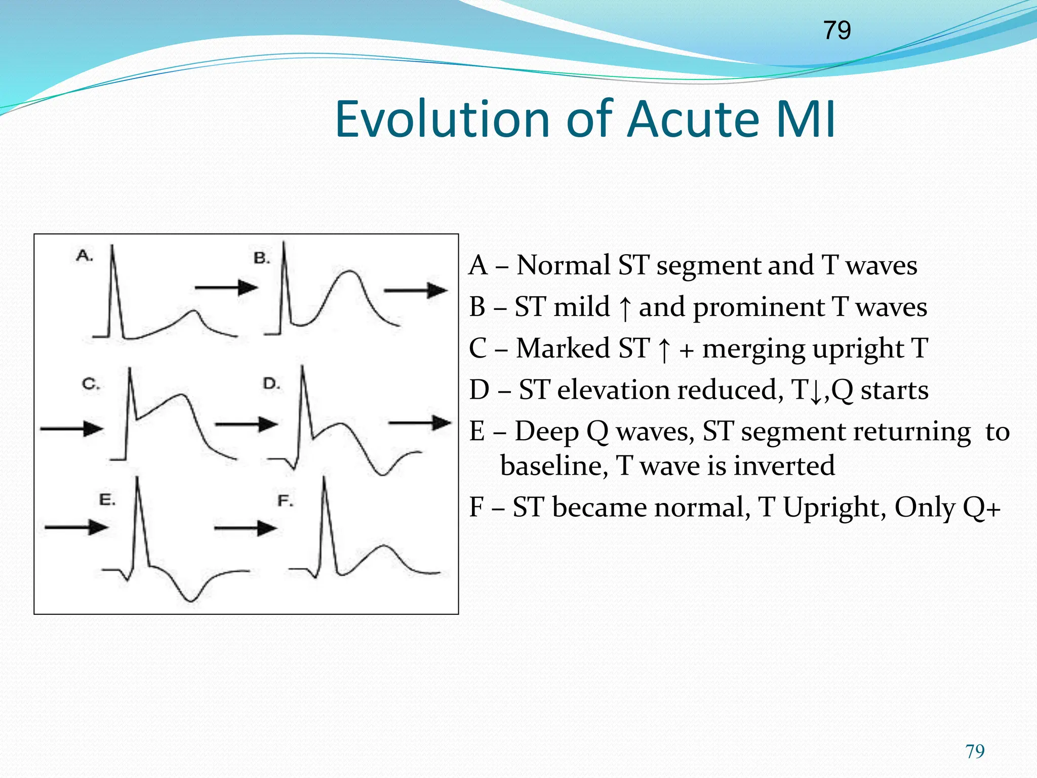 79
79
Evolution of Acute MI
A – Normal ST segment and T waves
B – ST mild ↑ and prominent T waves
C – Marked ST ↑ + merging upright T
D – ST elevation reduced, T↓,Q starts
E – Deep Q waves, ST segment returning to
baseline, T wave is inverted
F – ST became normal, T Upright, Only Q+
 