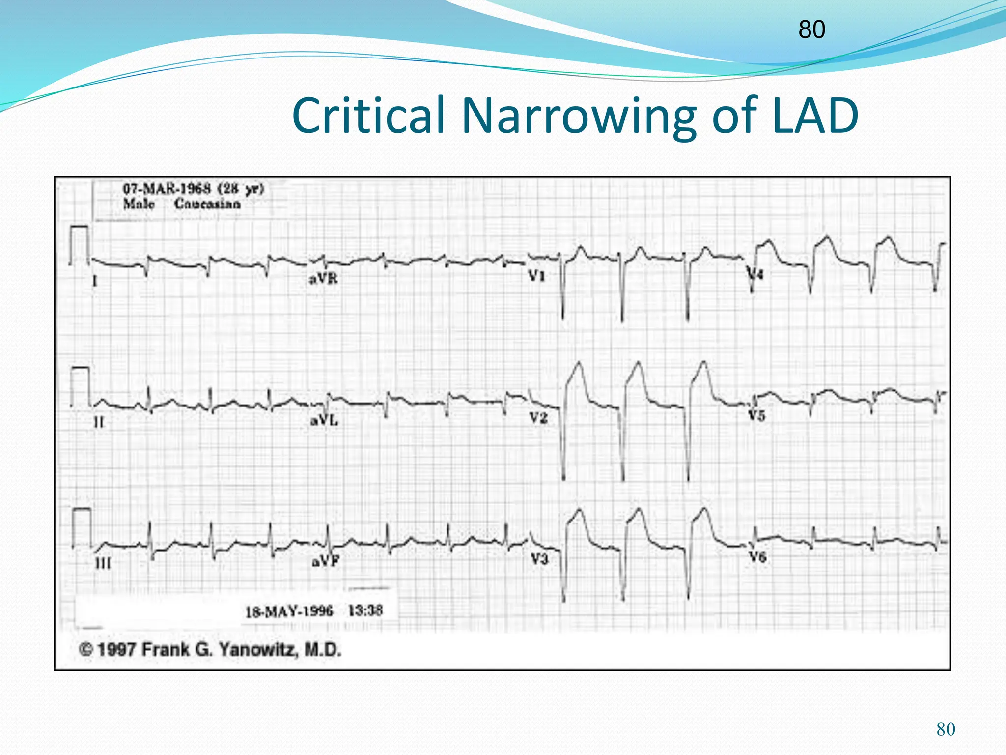80
80
Critical Narrowing of LAD
 