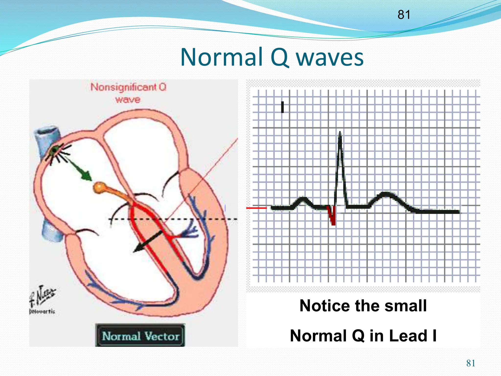 81
81
Normal Q waves
Notice the small
Normal Q in Lead I
 