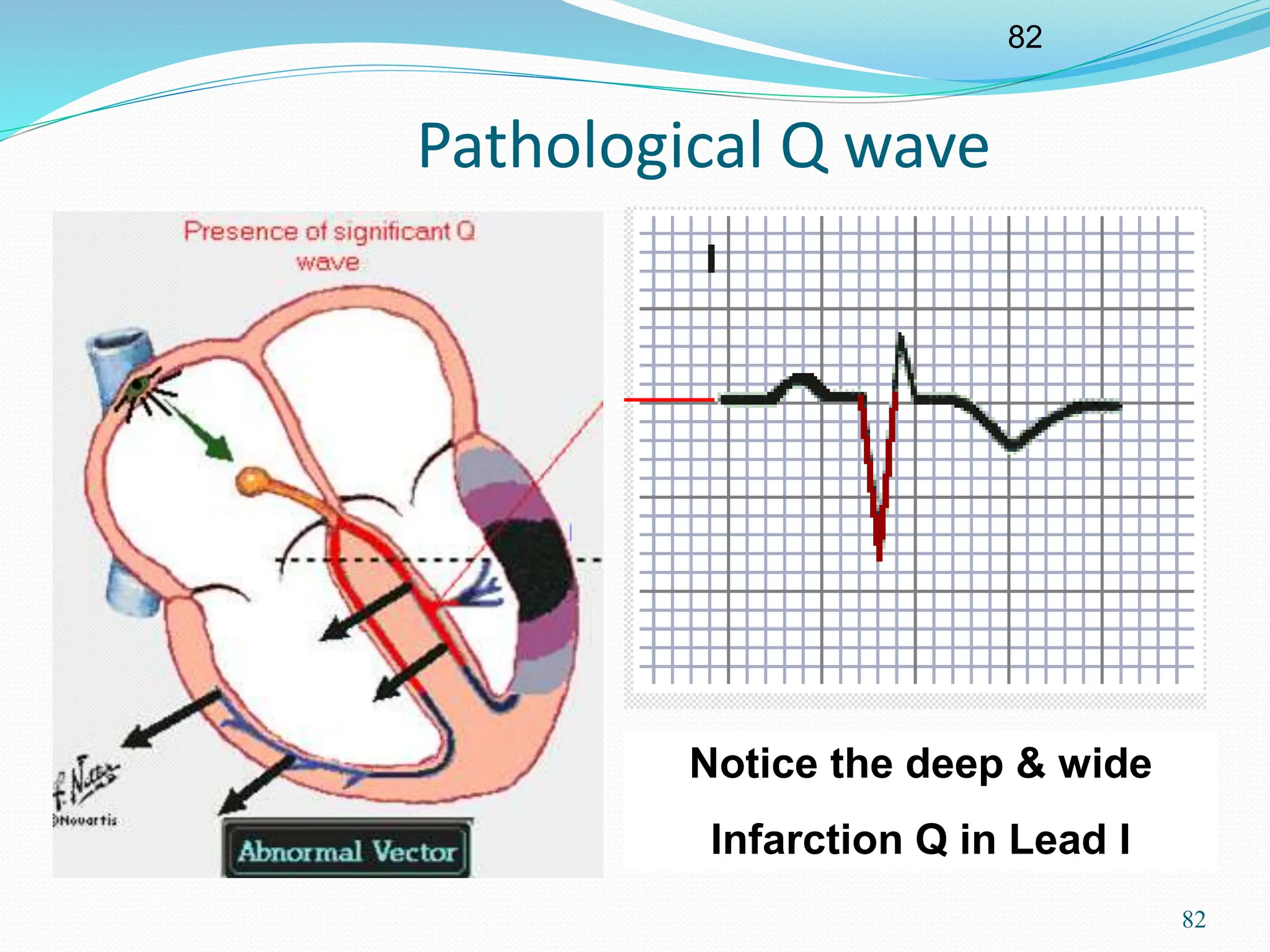 82
82
Pathological Q wave
Notice the deep & wide
Infarction Q in Lead I
 