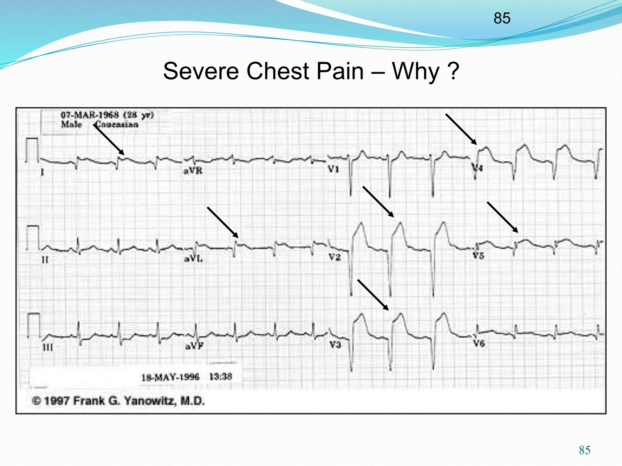85
85
Severe Chest Pain – Why ?
 