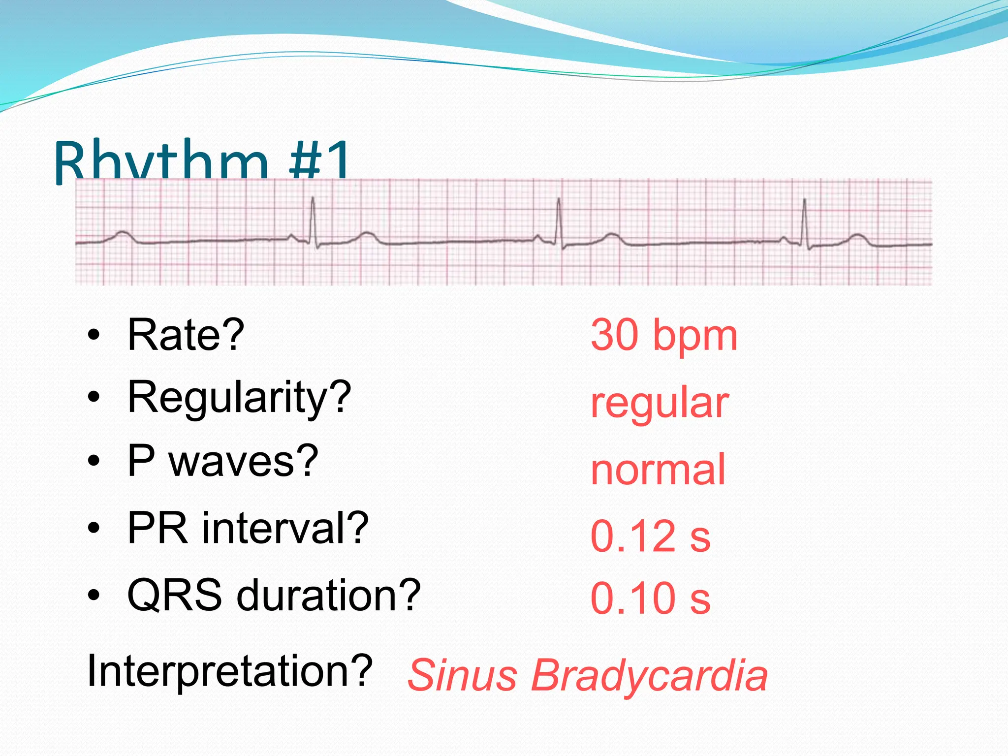 Rhythm #1
30 bpm
• Rate?
• Regularity? regular
normal
0.10 s
• P waves?
• PR interval? 0.12 s
• QRS duration?
Interpretation? Sinus Bradycardia
 