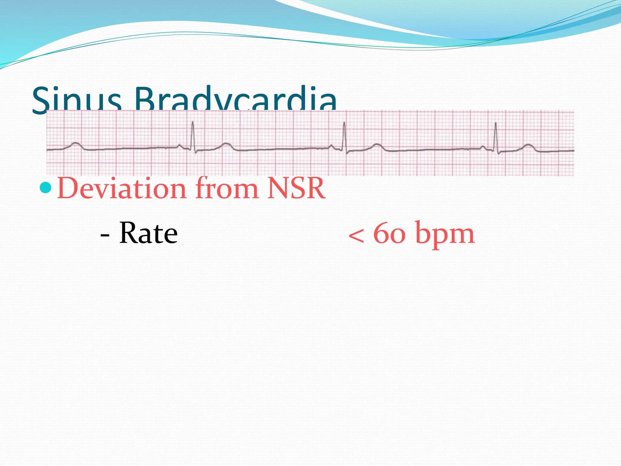 Sinus Bradycardia
Deviation from NSR
- Rate < 60 bpm
 