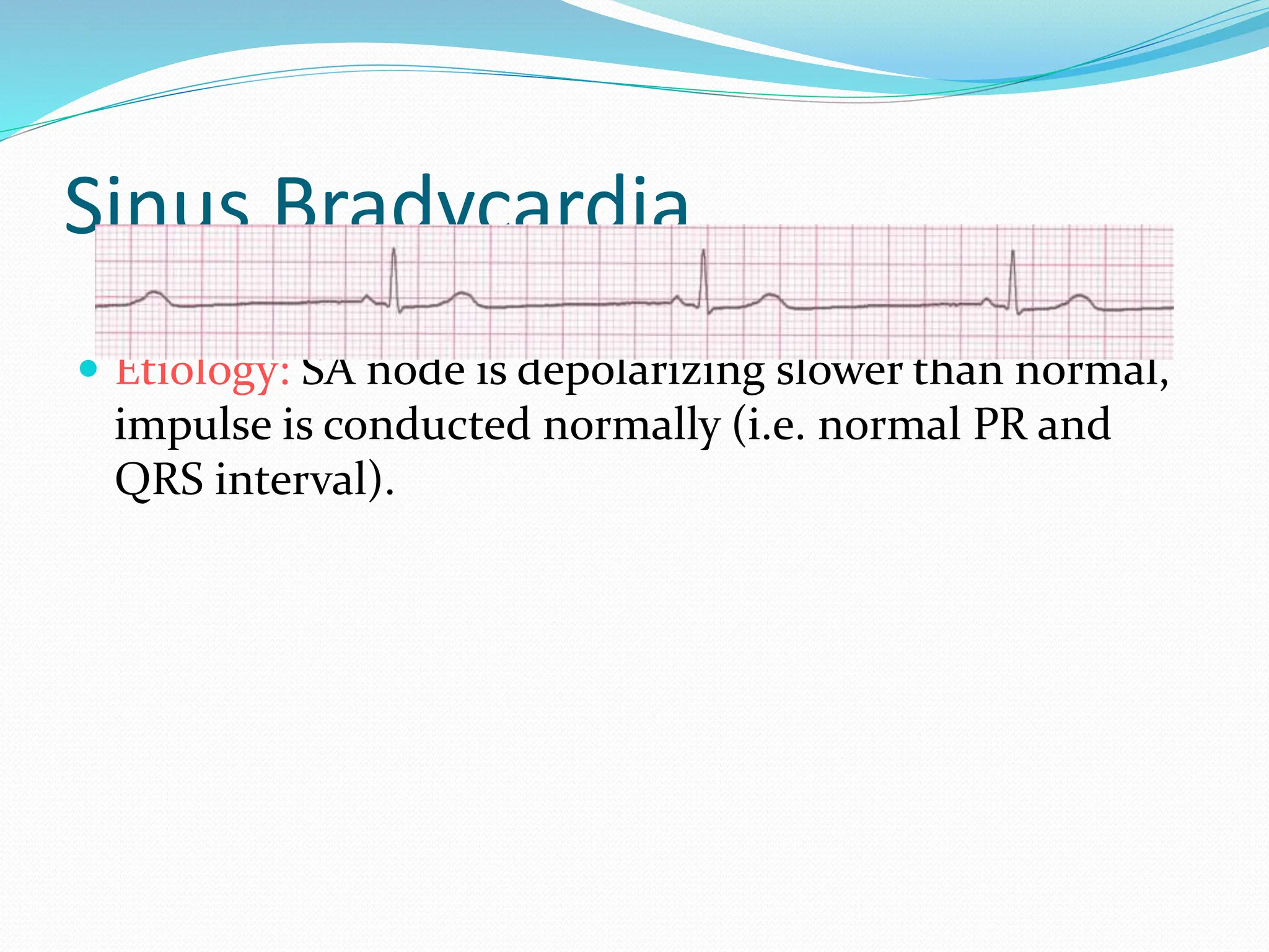 Sinus Bradycardia
 Etiology: SA node is depolarizing slower than normal,
impulse is conducted normally (i.e. normal PR and
QRS interval).
 