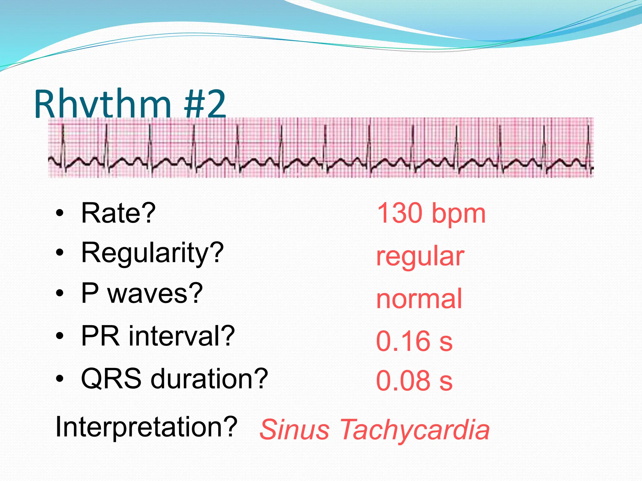 Rhythm #2
130 bpm
• Rate?
• Regularity? regular
normal
0.08 s
• P waves?
• PR interval? 0.16 s
• QRS duration?
Interpretation? Sinus Tachycardia
 
