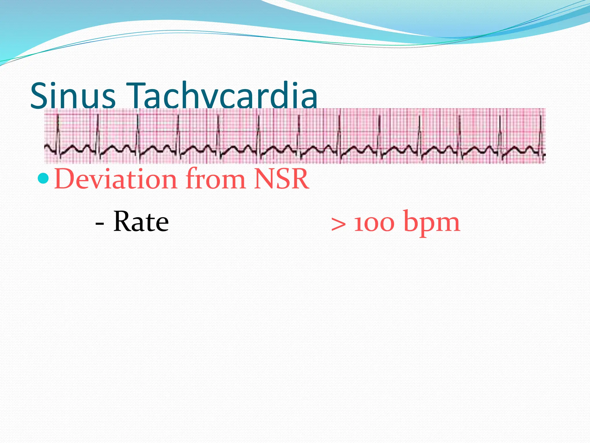 Sinus Tachycardia
Deviation from NSR
- Rate > 100 bpm
 
