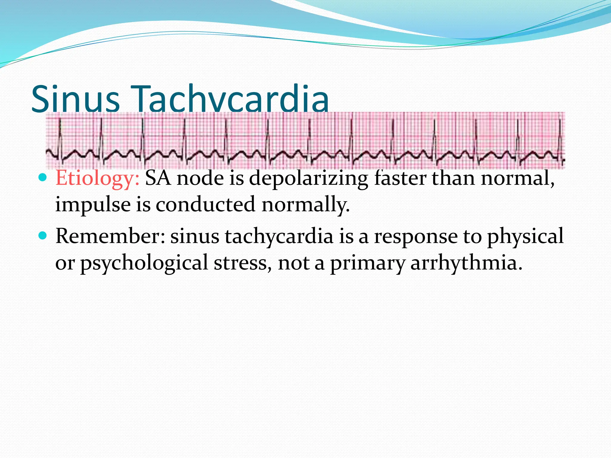 Sinus Tachycardia
 Etiology: SA node is depolarizing faster than normal,
impulse is conducted normally.
 Remember: sinus tachycardia is a response to physical
or psychological stress, not a primary arrhythmia.
 