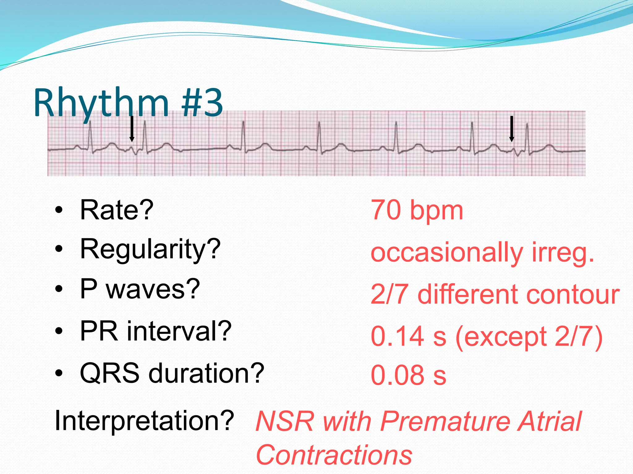Rhythm #3
70 bpm
• Rate?
• Regularity? occasionally irreg.
2/7 different contour
0.08 s
• P waves?
• PR interval? 0.14 s (except 2/7)
• QRS duration?
Interpretation? NSR with Premature Atrial
Contractions
 