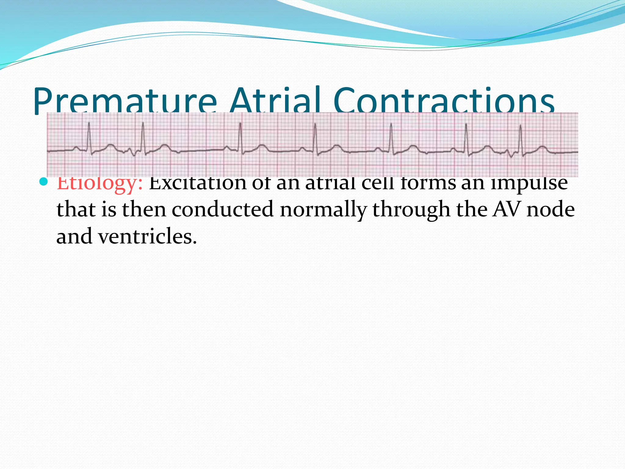 Premature Atrial Contractions
 Etiology: Excitation of an atrial cell forms an impulse
that is then conducted normally through the AV node
and ventricles.
 