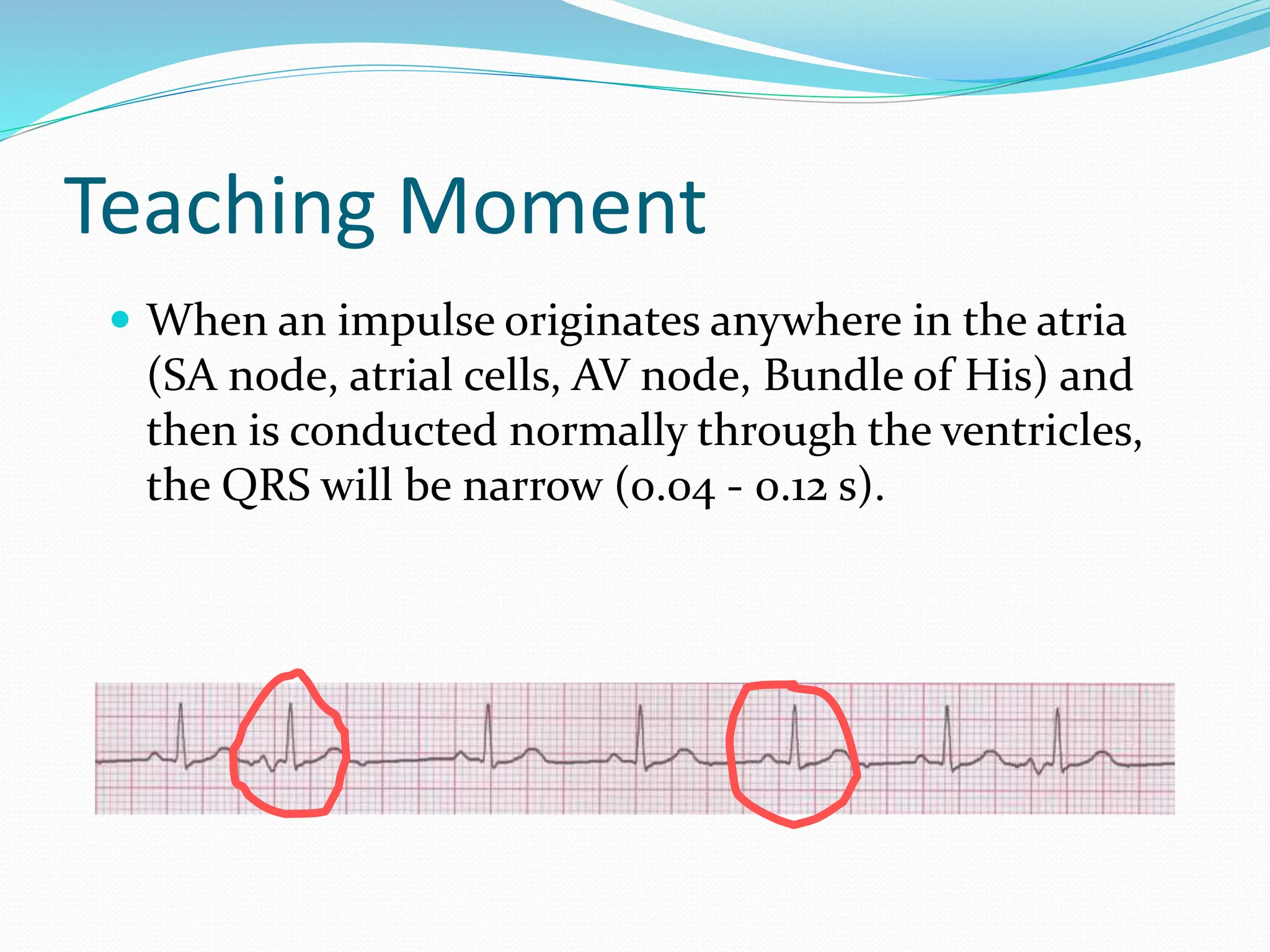 Teaching Moment
 When an impulse originates anywhere in the atria
(SA node, atrial cells, AV node, Bundle of His) and
then is conducted normally through the ventricles,
the QRS will be narrow (0.04 - 0.12 s).
 