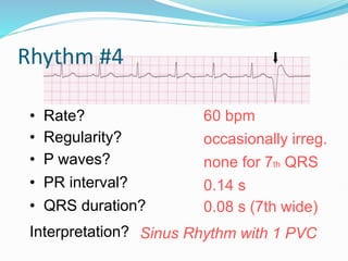 Rhythm #4
60 bpm
• Rate?
• Regularity? occasionally irreg.
none for 7th QRS
0.08 s (7th wide)
• P waves?
• PR interval? 0.14 s
• QRS duration?
Interpretation? Sinus Rhythm with 1 PVC
 