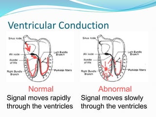 Ventricular Conduction
Normal
Signal moves rapidly
through the ventricles
Abnormal
Signal moves slowly
through the ventricles
 