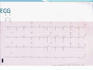 ECG
 