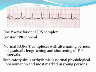One P wave for one QRS complex
Constant PR interval
Normal P,QRS,T complexes with alternating periods
of gradually lengthening and shortening of P-P
intervals.
Respiratory sinus arrhythmia is normal physiological
phenomenon and most marked in young persons.
 