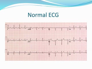 Normal ECG
 
