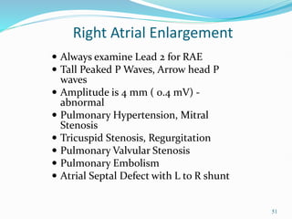 51
 Always examine Lead 2 for RAE
 Tall Peaked P Waves, Arrow head P
waves
 Amplitude is 4 mm ( 0.4 mV) -
abnormal
 Pulmonary Hypertension, Mitral
Stenosis
 Tricuspid Stenosis, Regurgitation
 Pulmonary Valvular Stenosis
 Pulmonary Embolism
 Atrial Septal Defect with L to R shunt
Right Atrial Enlargement
 