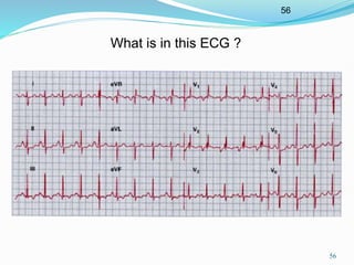 56
56
What is in this ECG ?
 