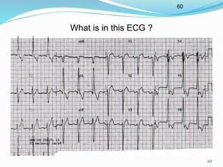 60
60
What is in this ECG ?
 