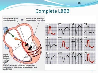 68
68
Complete LBBB
 