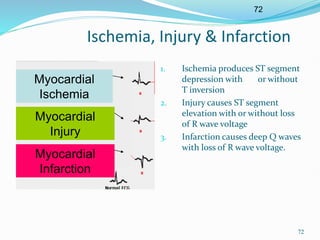 72
72
Ischemia, Injury & Infarction
Myocardial
Ischemia
Myocardial
Injury
Myocardial
Infarction
1. Ischemia produces ST segment
depression with or without
T inversion
2. Injury causes ST segment
elevation with or without loss
of R wave voltage
3. Infarction causes deep Q waves
with loss of R wave voltage.
 