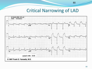 80
80
Critical Narrowing of LAD
 
