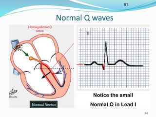 81
81
Normal Q waves
Notice the small
Normal Q in Lead I
 