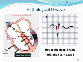 82
82
Pathological Q wave
Notice the deep & wide
Infarction Q in Lead I
 