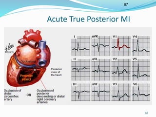 87
87
Acute True Posterior MI
 