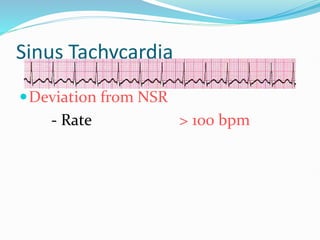 Sinus Tachycardia
Deviation from NSR
- Rate > 100 bpm
 