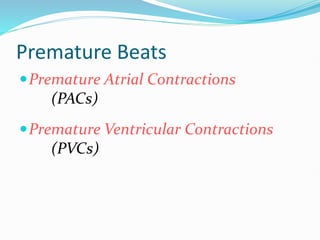Premature Beats
Premature Atrial Contractions
(PACs)
Premature Ventricular Contractions
(PVCs)
 