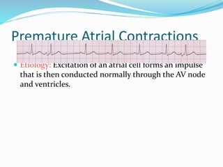 Premature Atrial Contractions
 Etiology: Excitation of an atrial cell forms an impulse
that is then conducted normally through the AV node
and ventricles.
 
