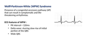 Wolff-Parkinson-White (WPW) Syndrome
Presence of a congenital accessory pathway (AP)
that can result in symptomatic and life-
threatening arrhythmias.
ECG features of WPW :
• PR interval < 120ms
• Delta wave: slurring slow rise of initial
portion of the QRS
• Wide QRS
 