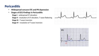 Pericarditis
• Widespread concave STE and PR depression
• Stages of ECG Findings in Pericarditis
Stage I - widespread ST elevation
Stage II - resolution of ST elevation, T wave flattening
Stage III - T wave inversion
Stage IV - resolution of T wave inversion
 