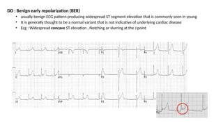 DD : Benign early repolarization (BER)
• usually benign ECG pattern producing widespread ST segment elevation that is commonly seen in young
• It is generally thought to be a normal variant that is not indicative of underlying cardiac disease
• Ecg : Widespread concave ST elevation , Notching or slurring at the J point
 