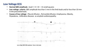 Low Voltage ECG
• Normal QRS amplitude : lead I + II + III > 15 small squares
• Low voltage criteria :QRS amplitude less than 5 mm in the limb leads and/or less than 10 mm
in the precordial leads.
• Causes of low voltage : Pleural effusion , Pericardial effusion, Emphysema, Obesity,
Myxedema , Infiltrative diseases as amyloid cardiomyopathy.
 
