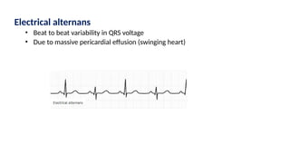 Electrical alternans
• Beat to beat variability in QRS voltage
• Due to massive pericardial effusion (swinging heart)
 
