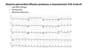 Massive pericardial effusion produces a characteristic ECG triad of:
• Low QRS voltage
• Tachycardia
• Electrical alternans
 