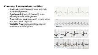 Common P Wave Abnormalities
• P mitrale (bifid P waves), seen with left
atrial enlargement
• P pulmonale (peaked P waves), seen
with right atrial enlargement
• P wave inversion, seen with ectopic atrial
and junctional rhythms
• Variable P wave morphology, seen in
multifocal atrial rhythms
 