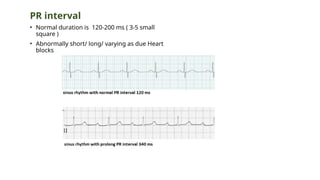 PR interval
• Normal duration is 120-200 ms ( 3-5 small
square )
• Abnormally short/ long/ varying as due Heart
blocks
 